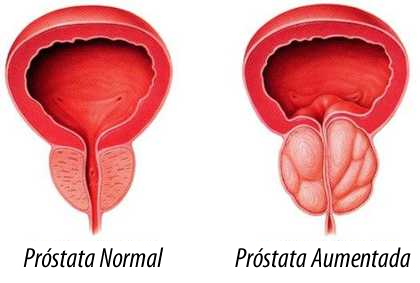 prostata-normal-e-prostata-aumentada